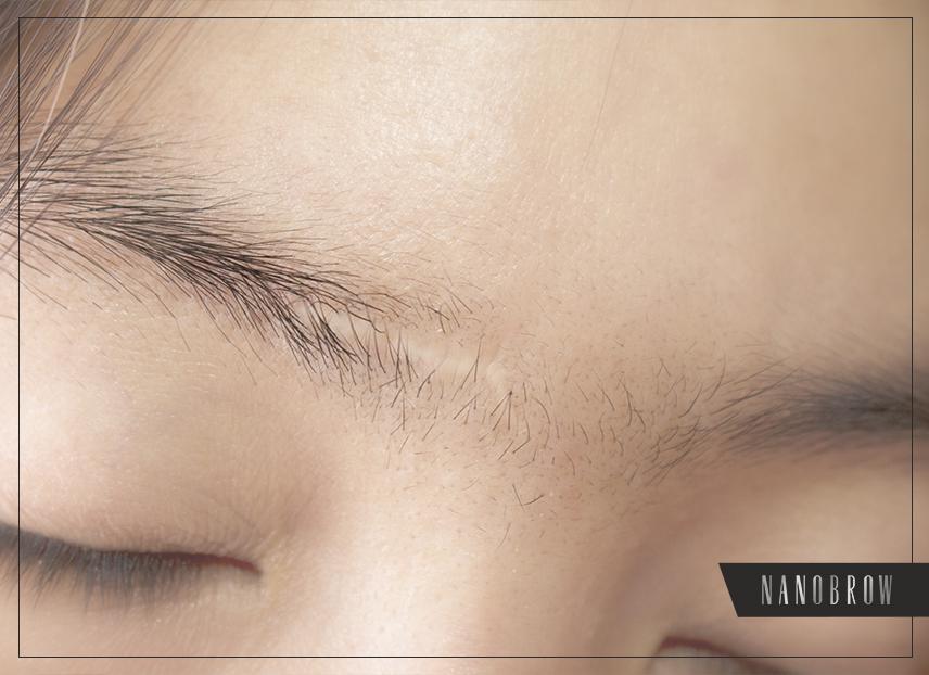 Cum camuflam o cicatrice din spranceana?